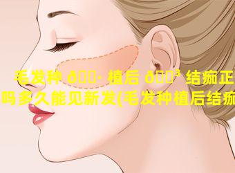 毛发种 🌷 植后 🐳 结痂正常吗多久能见新发(毛发种植后结痂正常吗多久能见新发芽)